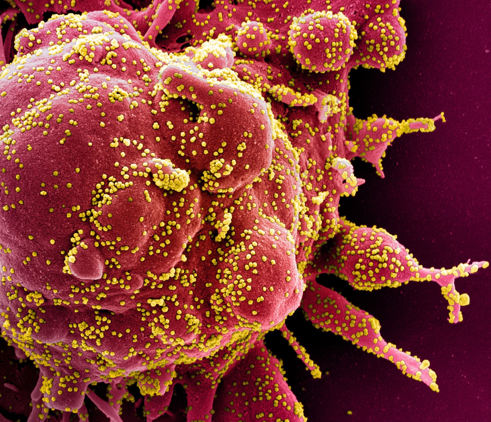 Colorized scanning electron micrograph of an apoptotic cell (red) heavily infected with SARS-COV-2 virus particles (yellow), isolated from a patient sample.